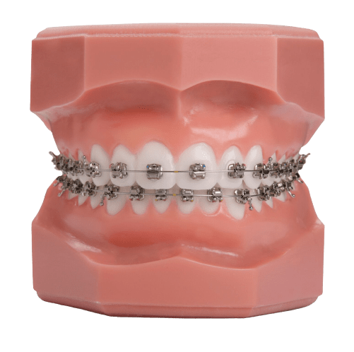 Self-Ligating Brackets